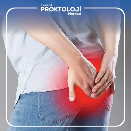 Anal Apse Tedavisi